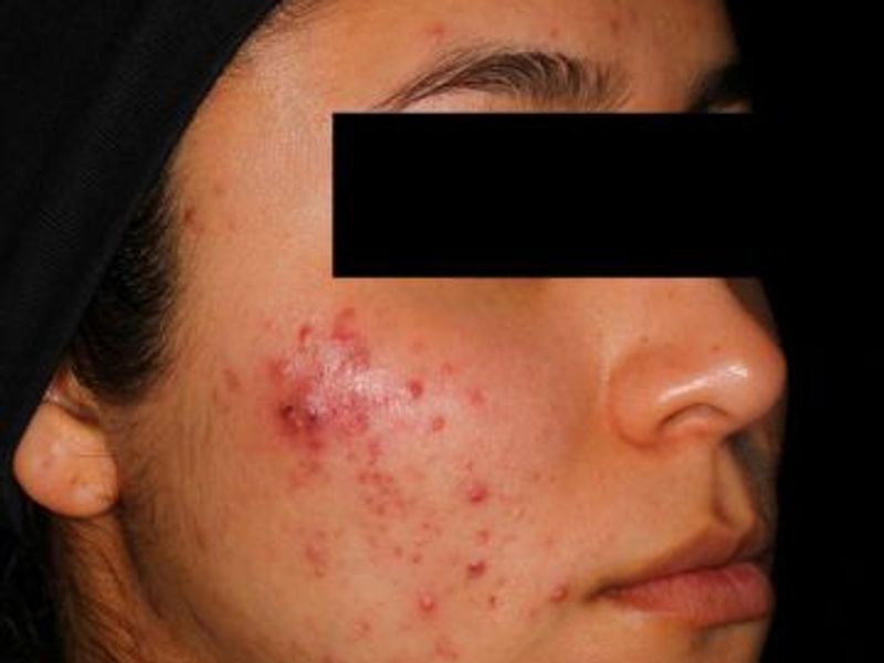 Before laser acne treatment in Montreal