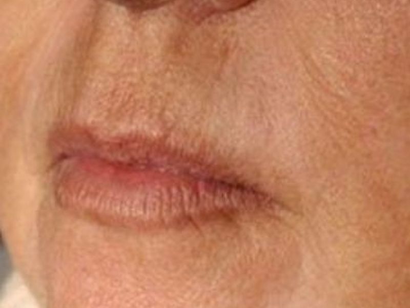 After Fotona Laser Skin Treatment for perioral wrinkles - Montreal