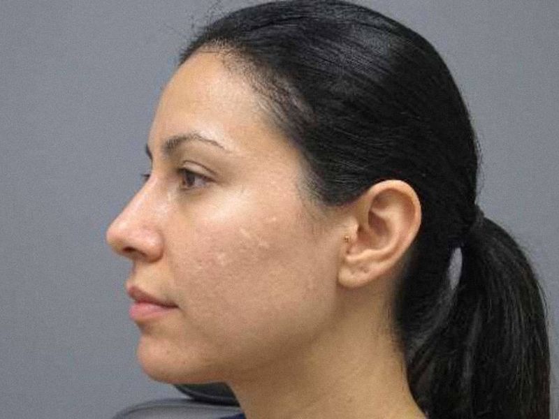 Illustration: the same woman with calmer, smoother skin across her cheek after exosomes following microneedling.