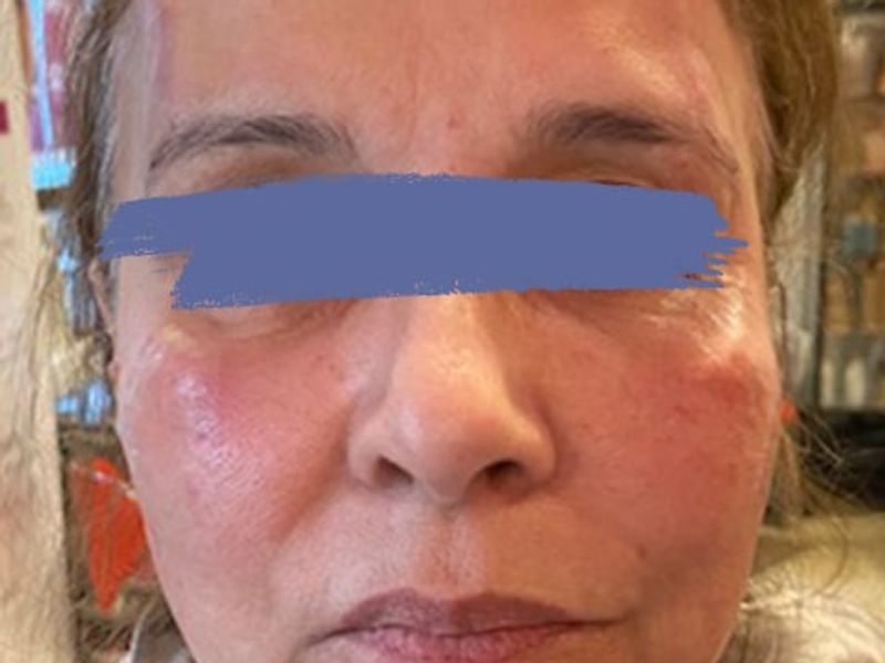 Female jaw and eyebrow after PDO thread lift procedure at our Montreal, Quebec aesthetic clinic