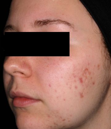 Before AviClear laser acne treatment in Montreal