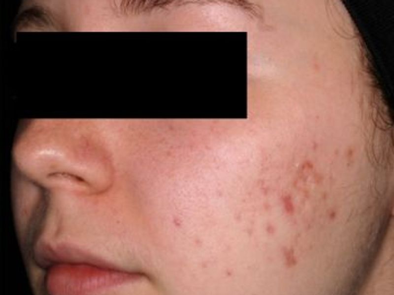 Before AviClear laser acne treatment in Montreal