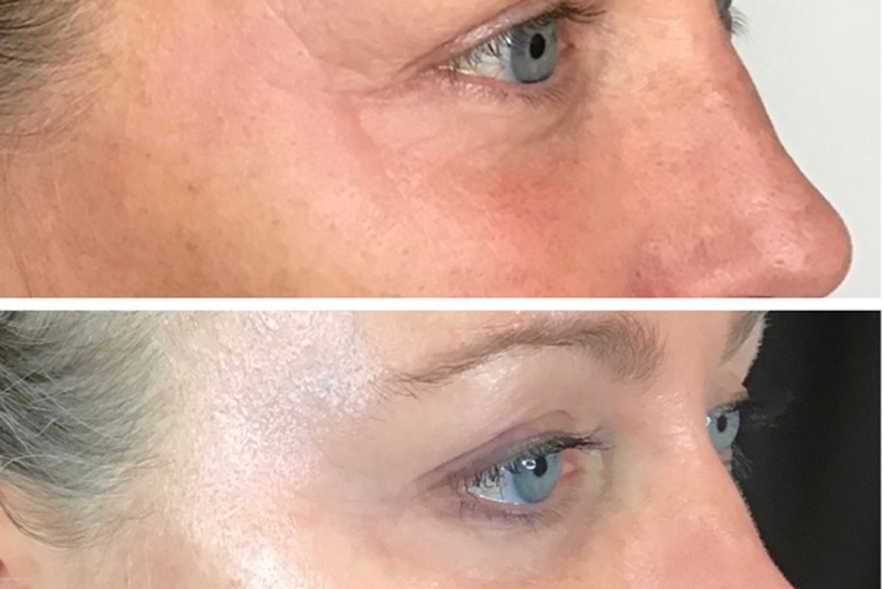Nitrogen Injection at Ideal Body Clinic