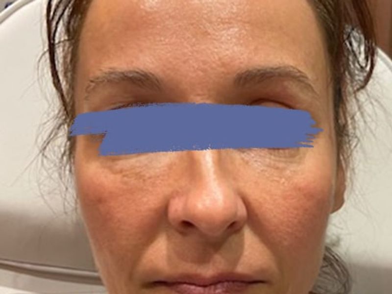 Female marionette lines before Before and After of PDO thread lift procedure at our Montreal, Quebec aesthetic clinic