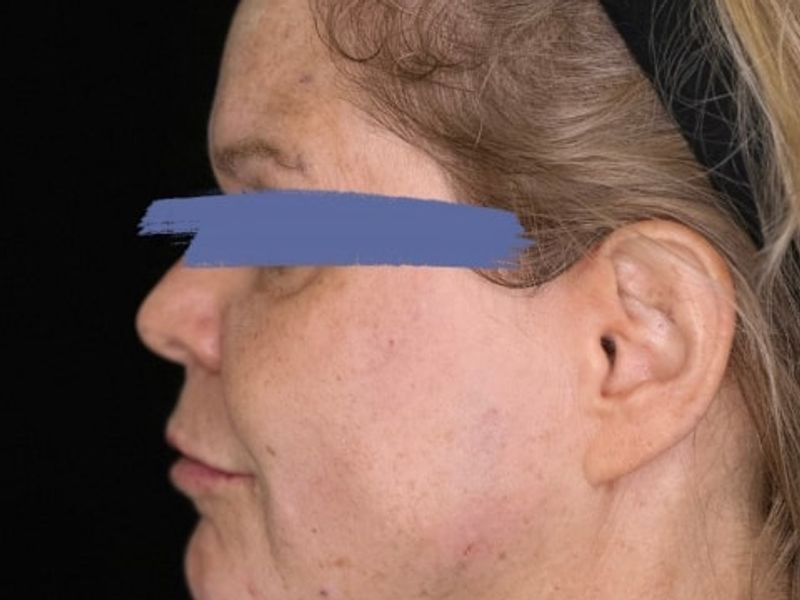 After Female Jawline PDO thread lift procedure at our Montreal, Quebec aesthetic clinic (side view)