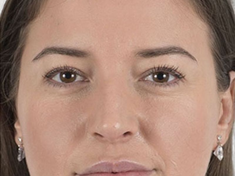 Before Aesthetic Hyaluronic acid lip fillers injectables in Montreal