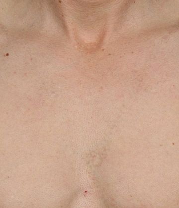 After CUTERA Enlighten Tatto Removal Montreal, chest picture