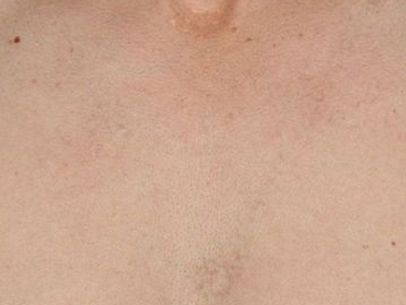 After CUTERA Enlighten Tatto Removal Montreal, chest picture