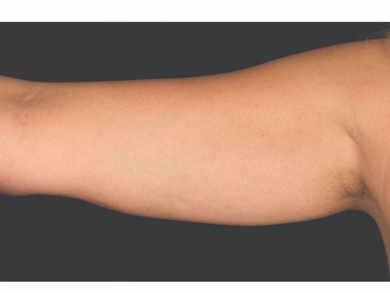 Arm fat After CoolSculpting Body Contouring fat loss Treatment in Montreal