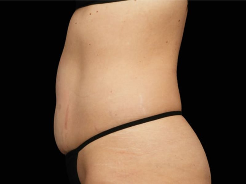 Stubborn belly fat After Emsculpt NEO Body Contouring fat removal therapy in Montreal