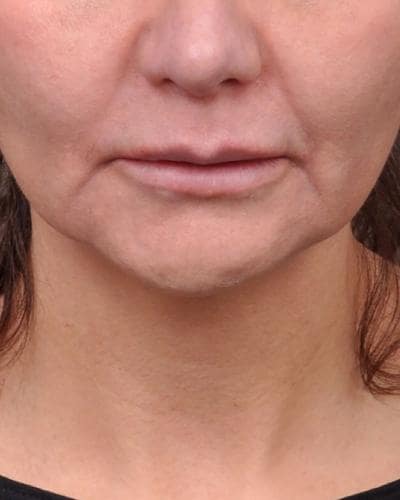 Before Profound RF Microneedling treatment for marionette lines - Montreal