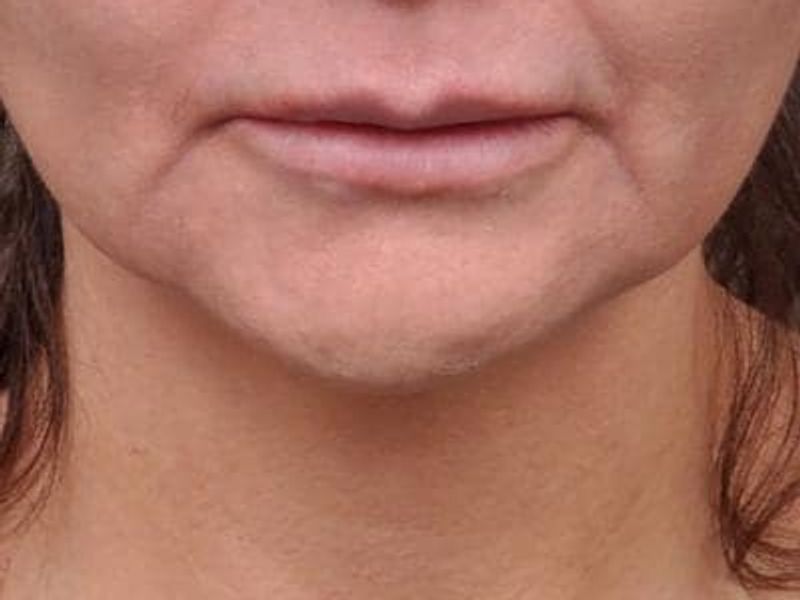 Before Profound RF Microneedling treatment for marionette lines - Montreal