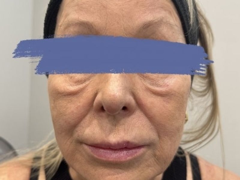Before Female Dermal Fillers procedure at our Montreal aesthetic clinic