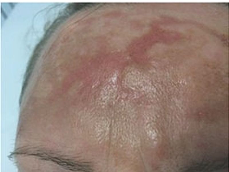 Patient before Scarlet-S RF treatment for burns - Ideal Body Clinic Montreal