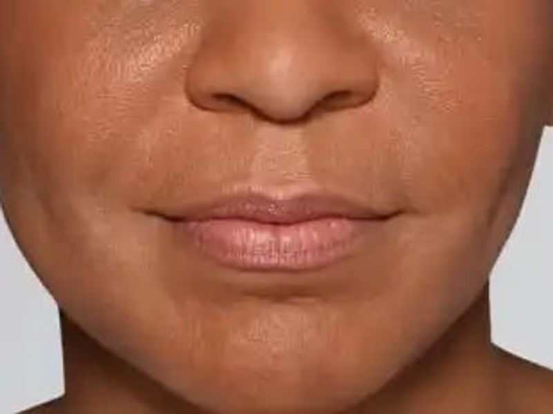 After Aesthetic Hyaluronic acid dermal fillers injectables in Montreal