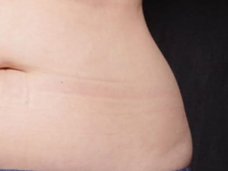 Before love handles picture Venus Bliss Max Contouring treatment