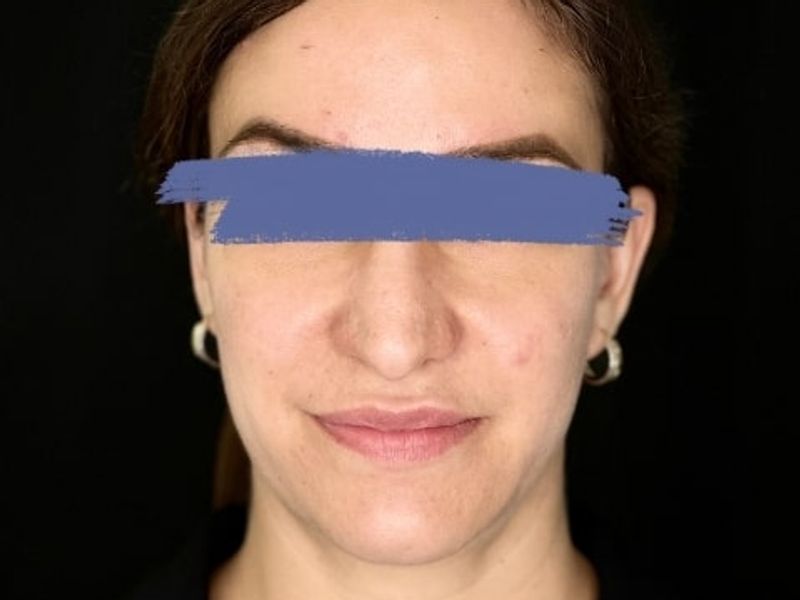 Before Female Cheeks and Lips Dermal Fillers procedure at our Montreal aesthetic clinic