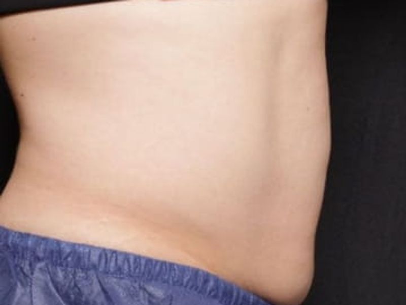 After fat abdomen picture Venus Bliss Max Contouring in Montreal