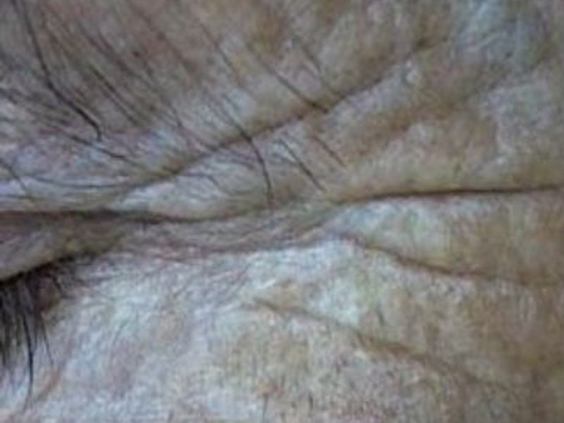 Before Fotona Laser Skin Treatment for eye wrinkles - Montreal