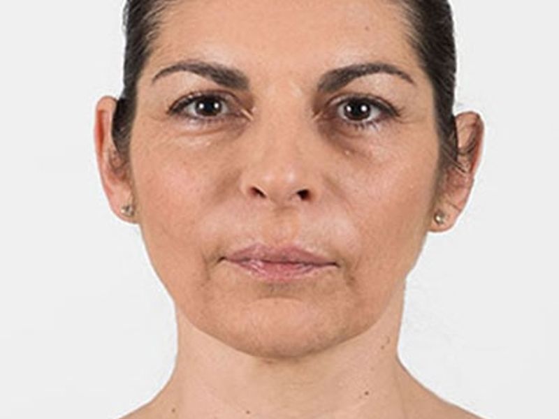 After Aesthetic Hyaluronic acid dermal fillers injectables in Montreal