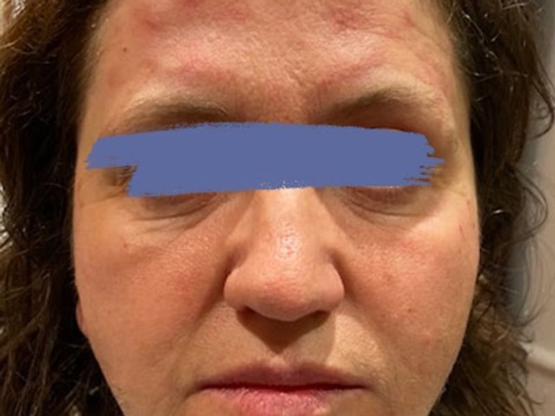 Female marionette lines before PDO thread lift procedure at our Montreal, Quebec aesthetic clinic