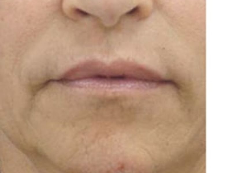 Patient after Scarlet-S RF treatment for mouth - Ideal Body Clinic Montreal