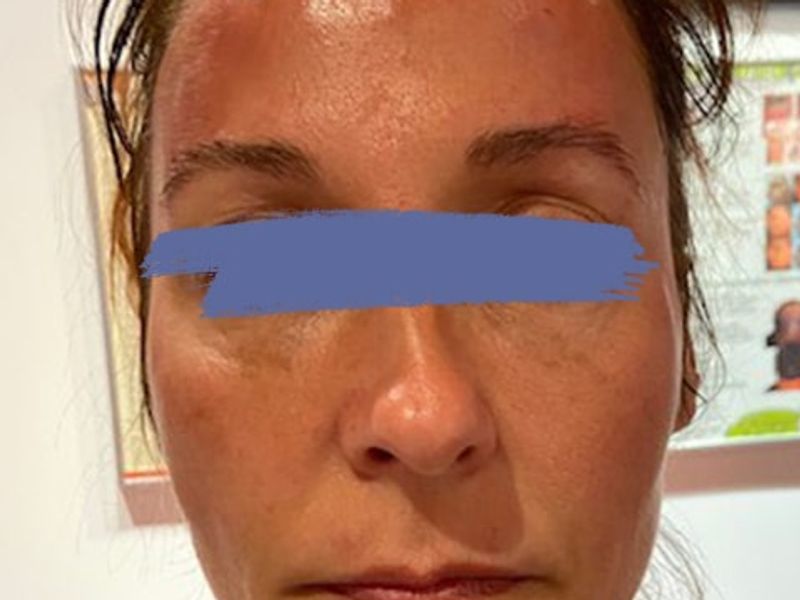 Female marionette lines after PDO thread lift procedure at our Montreal, Quebec aesthetic clinic