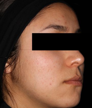 After laser acne treatment in Montreal