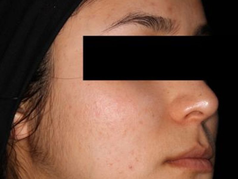 After laser acne treatment in Montreal