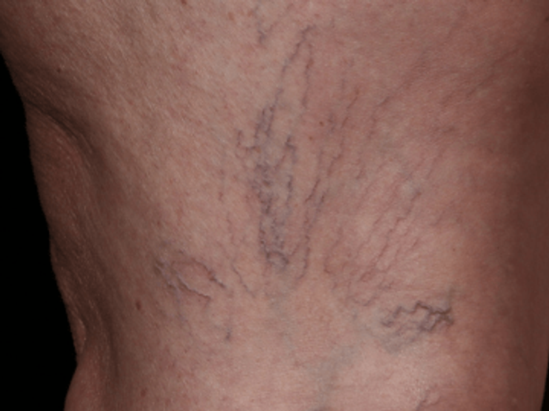 Spider vains removal before Excel HR treatment in Montreal