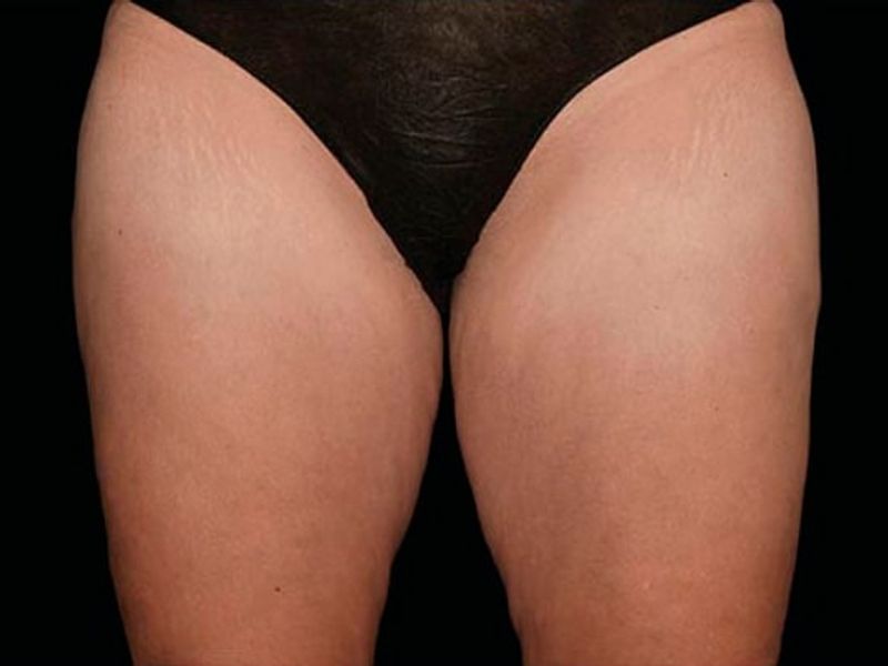 Thighs after CoolSculpting Body Contouring fat loss Treatment in Montreal
