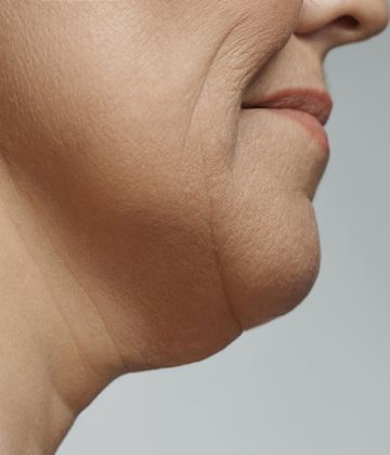 Fat-dissolving injection Treatments for double chin in Montreal Before pictures
