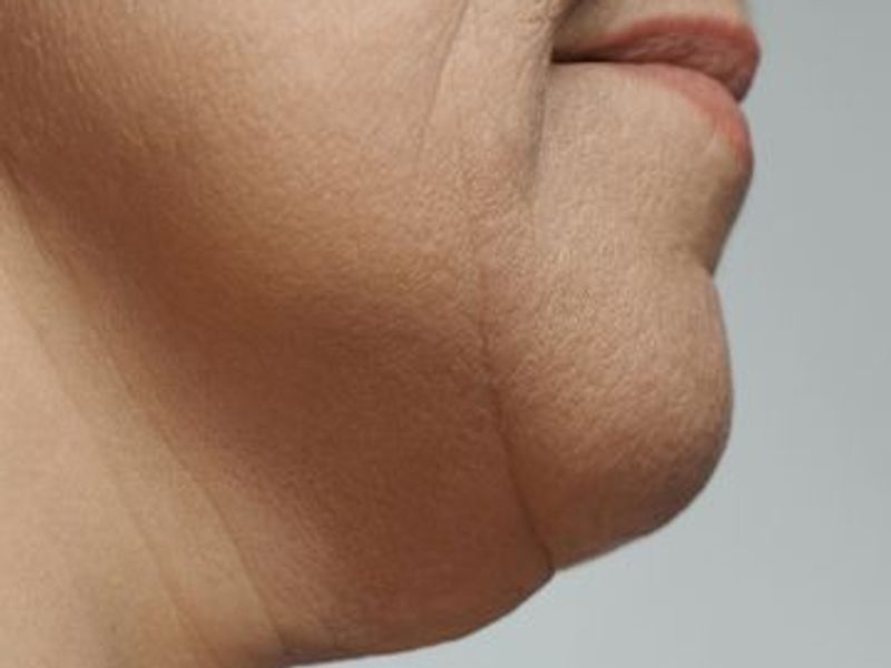 Fat-dissolving injection Treatments for double chin in Montreal Before pictures