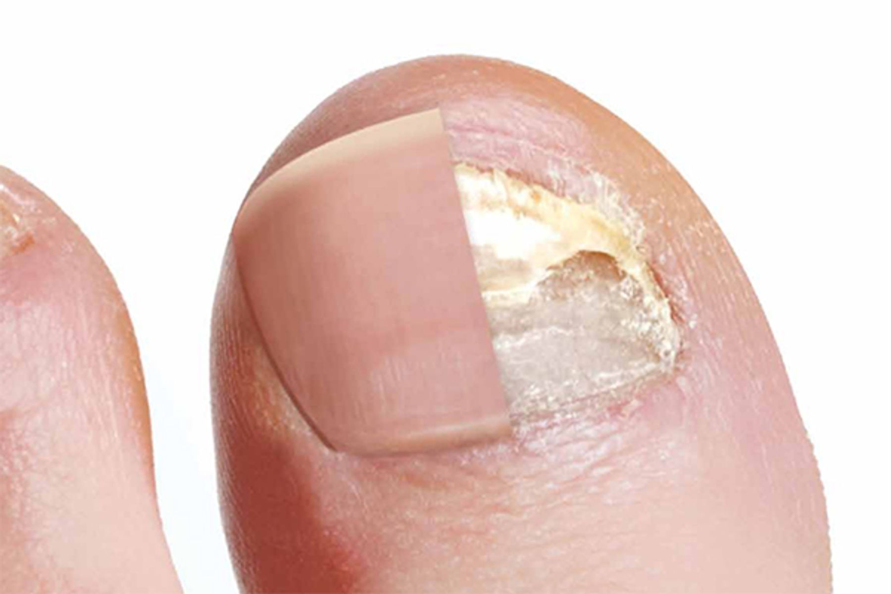 Say Goodbye to Nail Fungus: Effective Removal with Fotona Laser Treatment