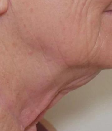 After submental and neck Sofwave Treatment Picture in Montreal