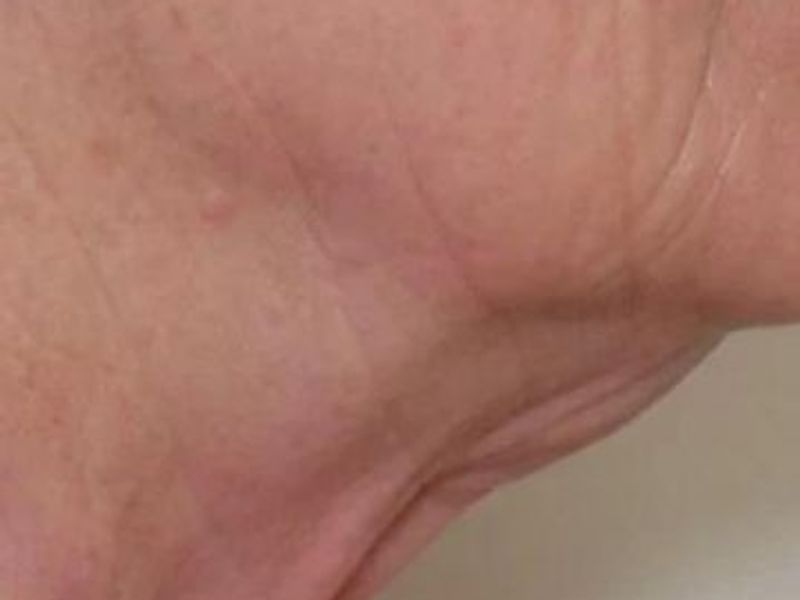 After submental and neck Sofwave Treatment Picture in Montreal
