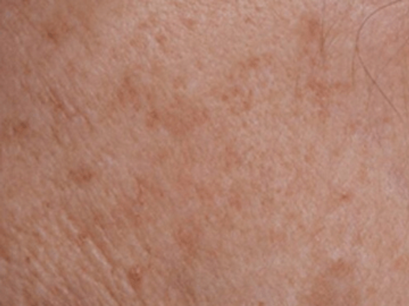 Skin spots removal after Excel HR treatment in Montreal
