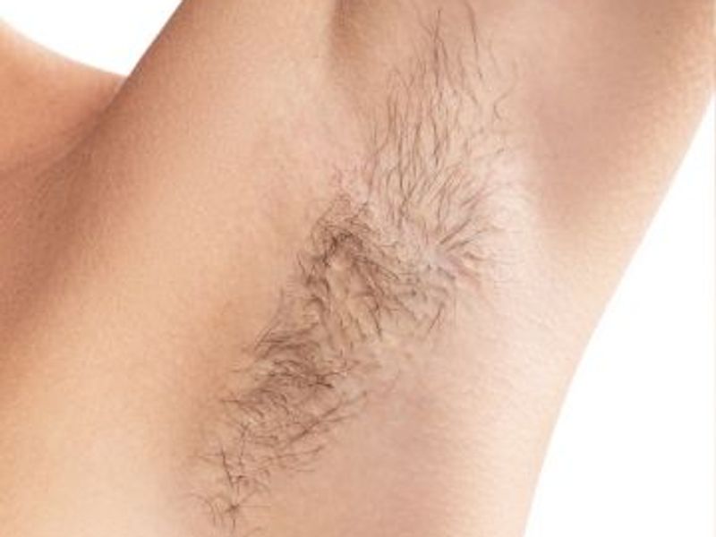 under arms (armpits) laser hair removal before treatment in Montreal