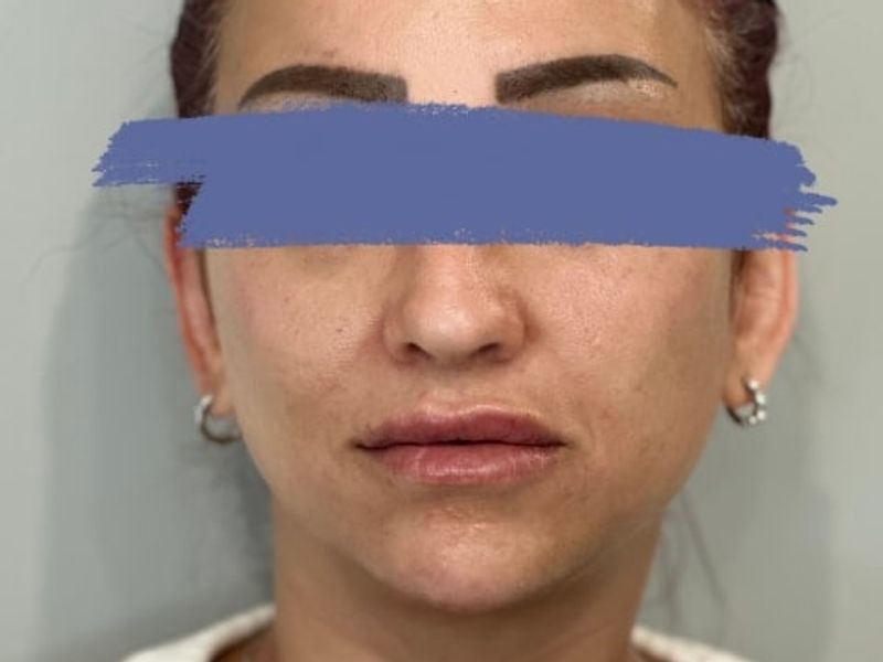 After Female Lip Fillers procedure at our Montreal aesthetic clinic
