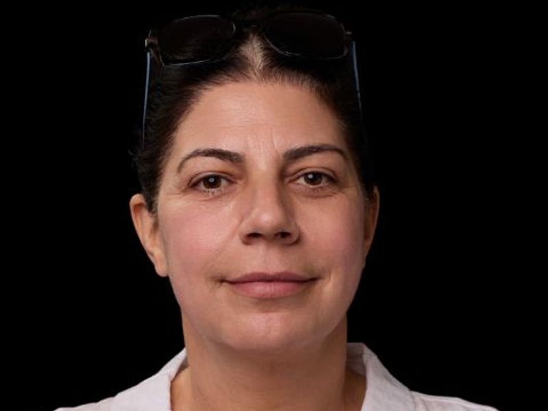 After picture: trilift under the eye treatment in Montreal