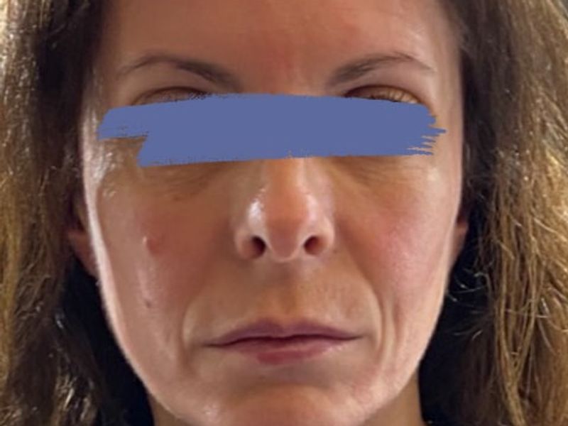 Before Female jowls lift procedure with PDO threads at our Montreal, Quebec aesthetic clinic