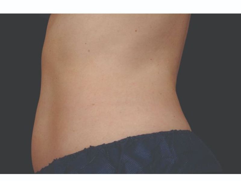 Abdomen and waist after CoolSculpting Body Contouring fat loss Treatment in Montreal
