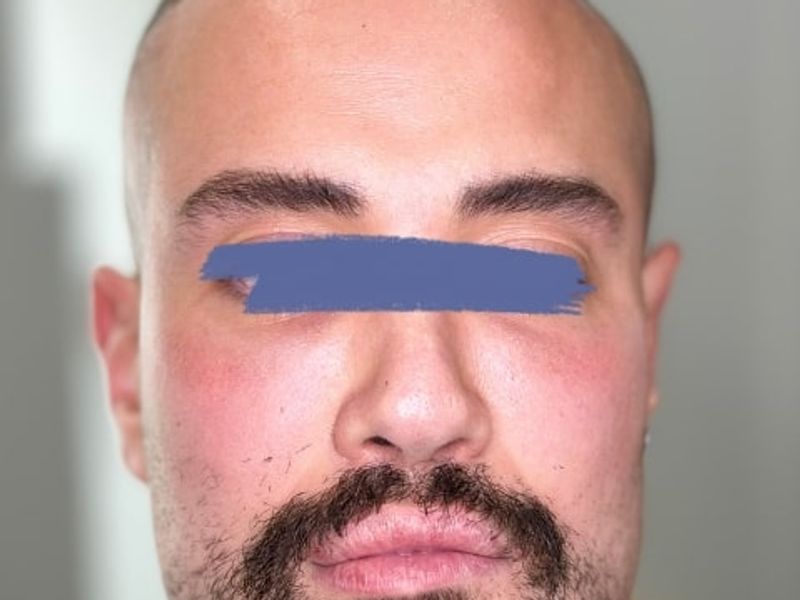 Before Male Cat Eyes PDO thread lift procedure at our Montreal aesthetic clinic