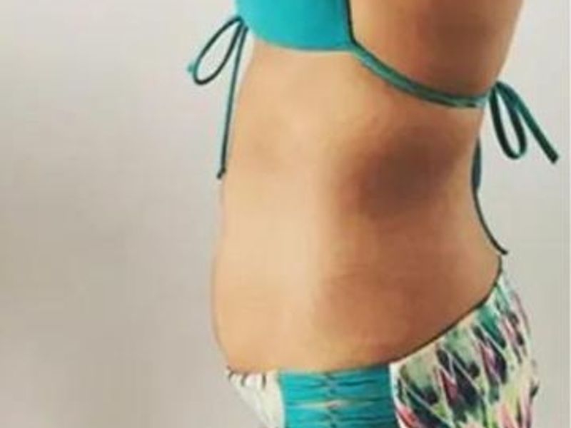 Belly fat After Slimwave Montreal treatment at Ideal Body Clinic