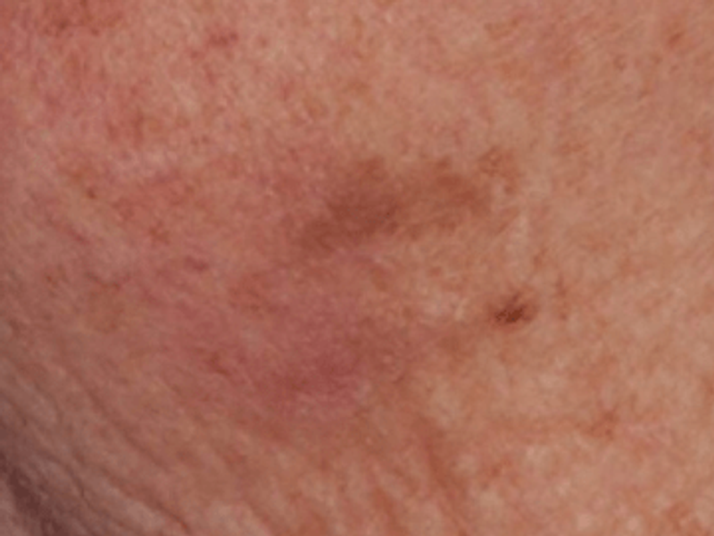 Facial pigmented lessions removal after Excel HR treatment in Montreal