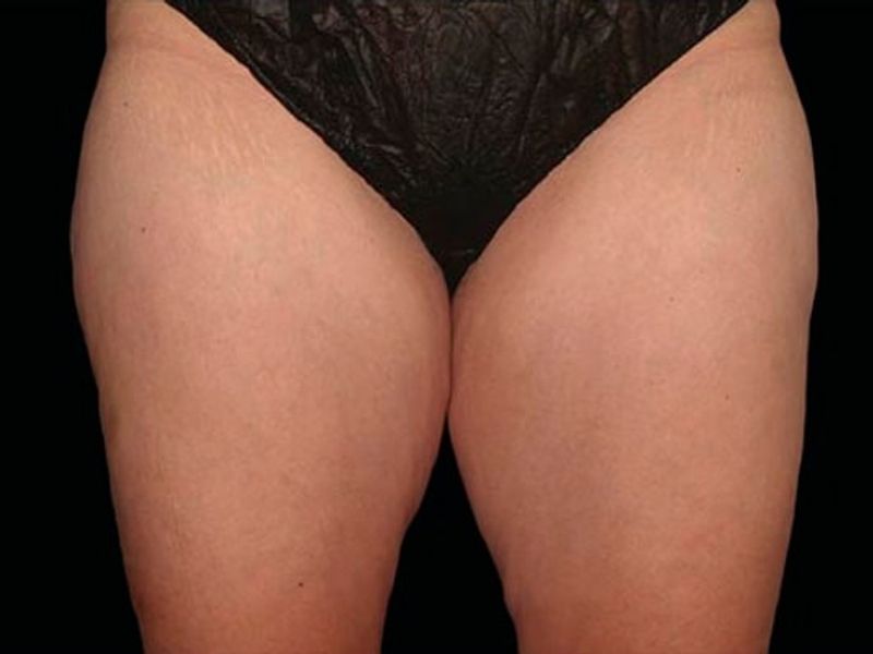 Thighs Before CoolSculpting Body Contouring fat loss Treatment in Montreal