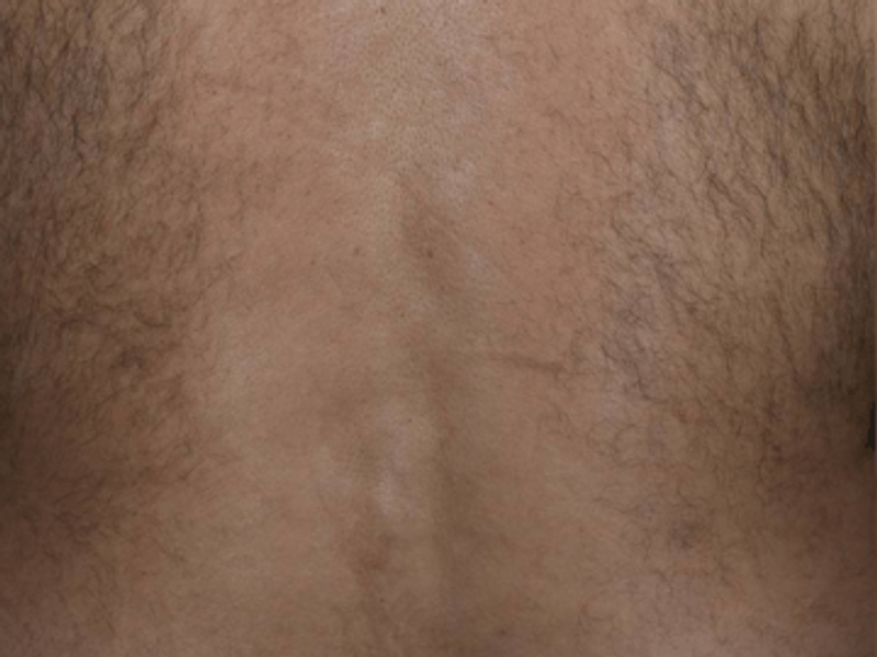 Back laser hair removal before Excel HR treatment in Montreal