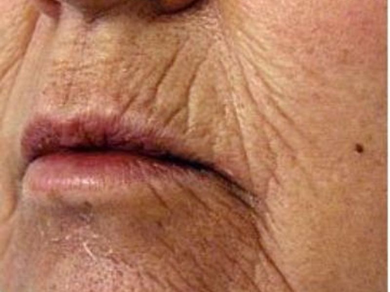 Before Fotona Laser Skin Treatment for perioral wrinkles - Montreal