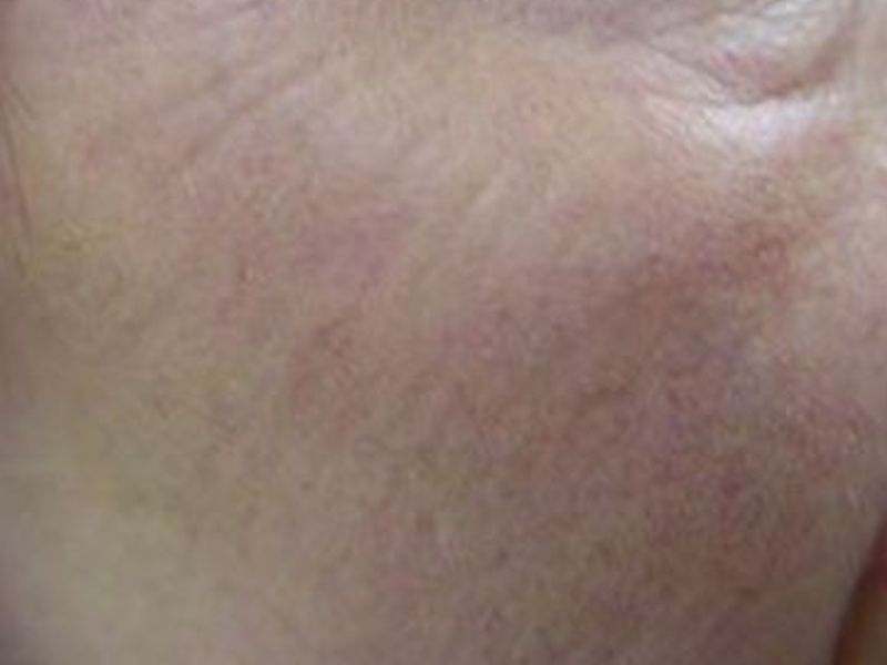 After Fotona Laser Skin Treatment for wrinkle resurfacing - Montreal