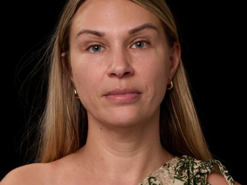 Before picture: triLift non surgical face lift treatment for middle age woman in Montreal at Ideal Body Clinic